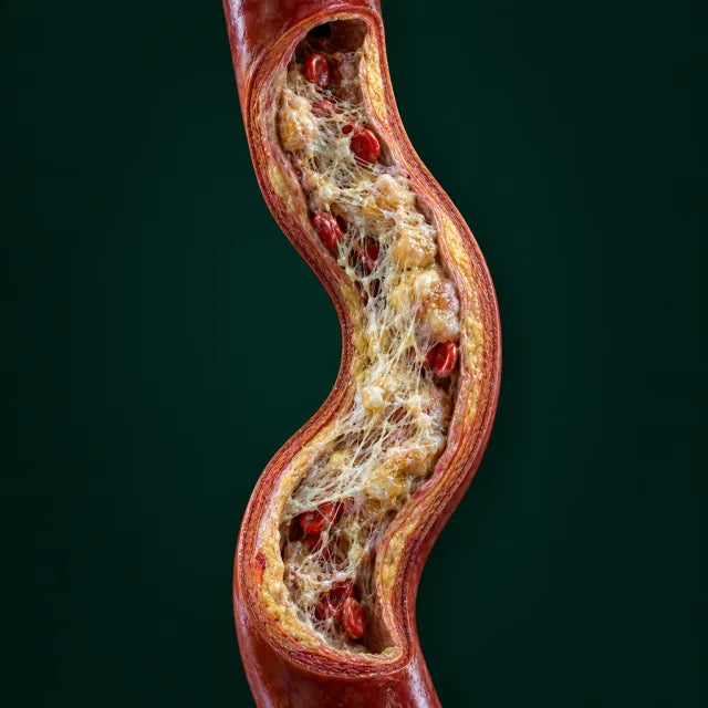 Artery narrowed by fibrin deposits
